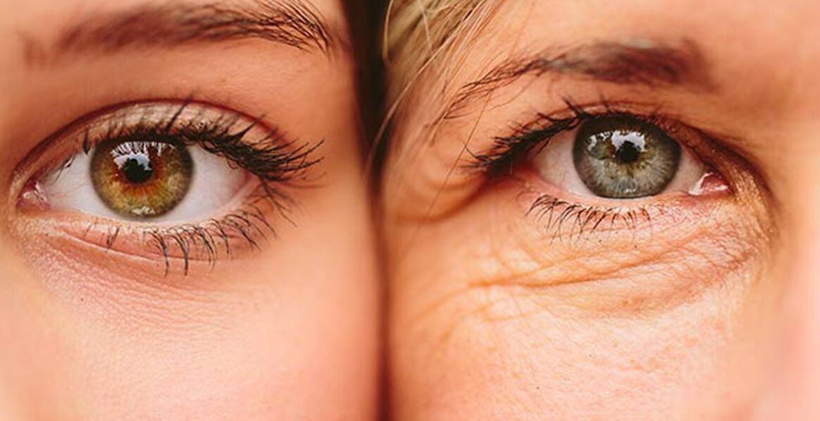 Semne externe ale îmbătrânirii pielii din jurul ochilor la două femei de vârste diferite