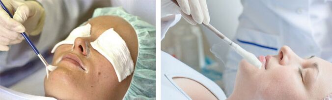 Peeling și crioterapie pentru întinerirea pielii