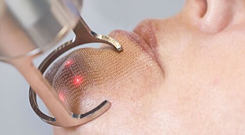 Cursul procedurii de întinerire a pielii faciale cu laser fracționat