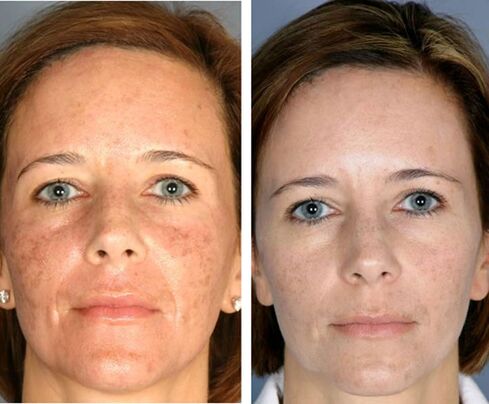 Înainte și după termoliza facială fracționată