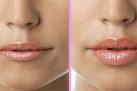 înainte și după refacerea buzelor